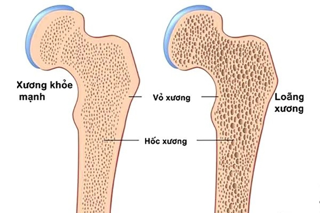 Loãng xương là một tình trạng rối loạn chuyển hóa của bộ xương làm giảm sức mạnh của xương dẫn đến làm tăng nguy cơ gãy xương.