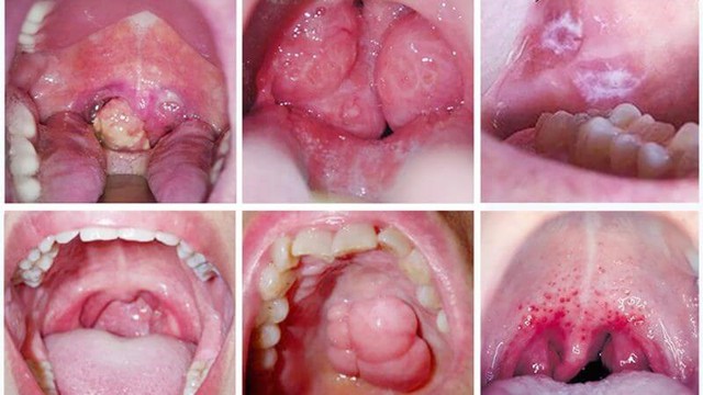 Ung thư khoang miệng là một tổn thương ác tính xuất hiện tại vùng khoang miệng.